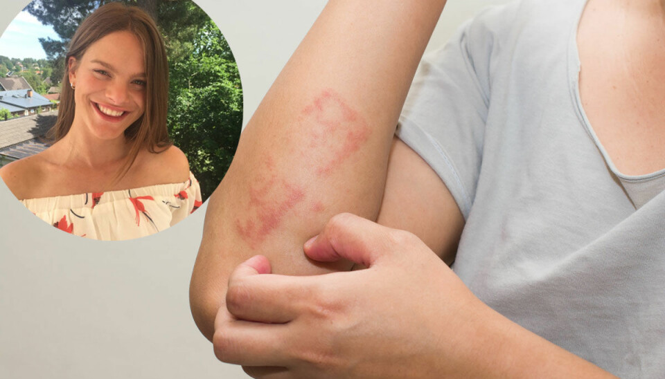Anna, 18 år: 'Så är det att leva med sjukdomen psoriasis'